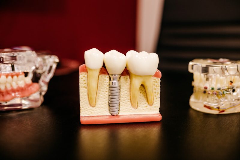 Hands-On Workshop: Implant Abutment Selection